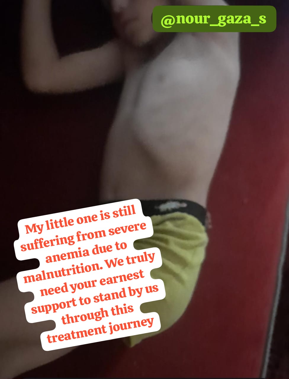 My little one is suffering from severe anemia due to malnutrition